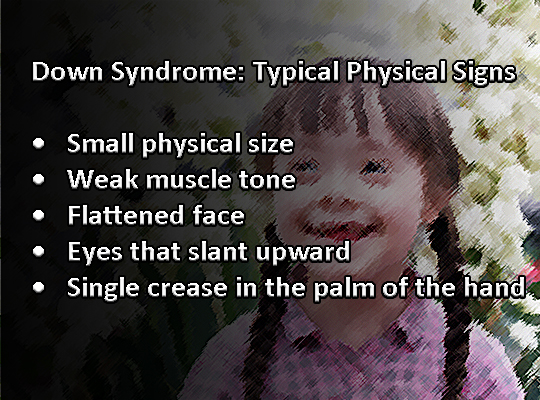 Down Syndrome