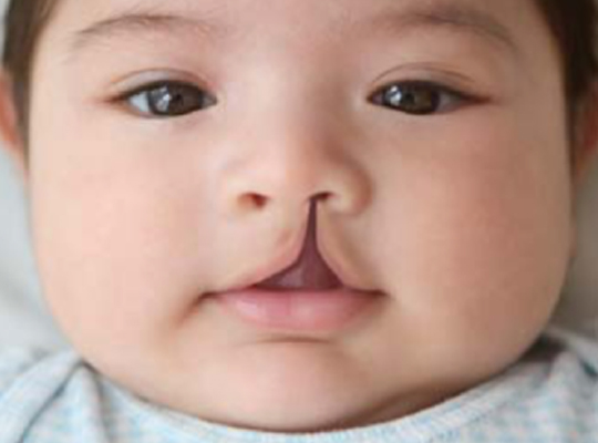 Cleft-lip palate speech Disorder